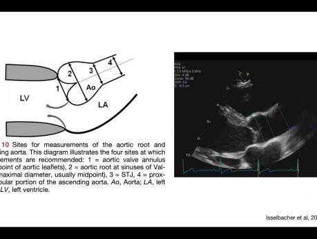 The Fifth Heart Chambe: Echocardiography Imaging Of The Thoracic Aorta