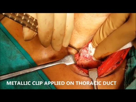 Chyle Leak in Neck from Thoracic Duct
