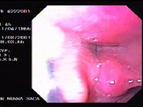 Oropharinx of a professional singer (1 of 2)