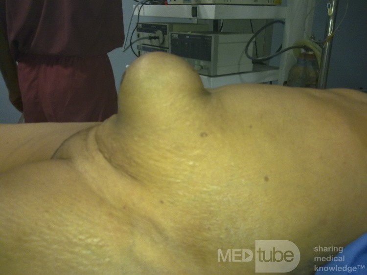 Umblical Hernia