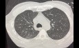 EVLP Usage Outcome in Patient with TV BE and DBD and ESRD
