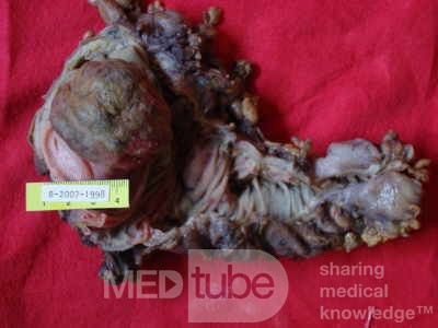 Non - Hodgkin's Lymphoma Of The Cecum (10 of 10)