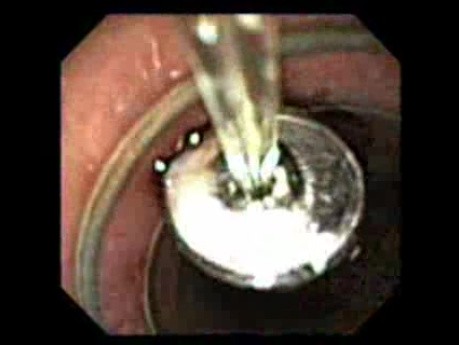 Ti-Knot Device - Passage Through Overtube