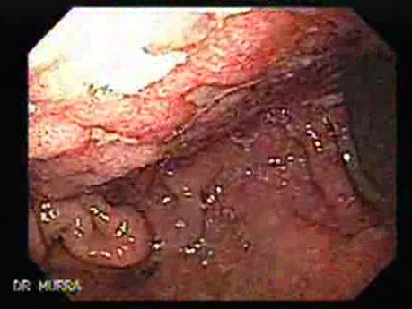 Primary Gastric Lymphoma Following Kidney Transplantation - 40 Years-Old Woman