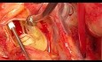 Aortic Root Replacement in Root Access 