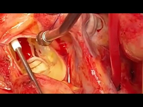Aortic Root Replacement in Root Access 