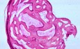 Osteoma of the External Canal [histology]