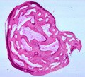 Osteoma of the External Canal [histology]