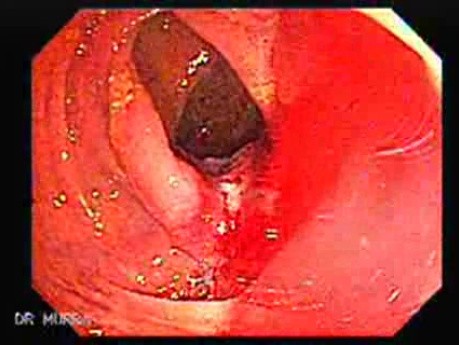Ascending Colon Cancer (6 of 6)