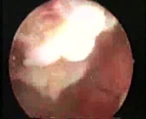 Hysteroscopic Treatment Of Intrauterine Myoma