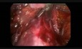 Laparoscopic Radical Hysterectomy + Pelvic Lymphadenectomy Cervical Cancer
