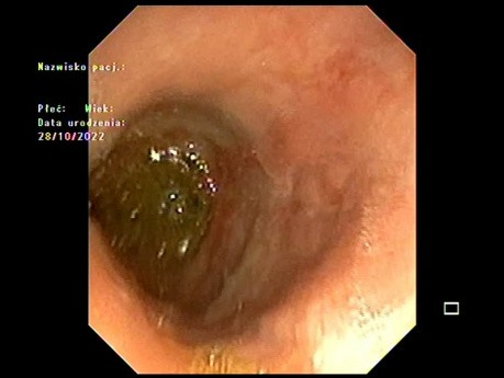 Esophageal Lesion - Early Cancer or ...?