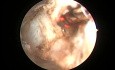 Greenlight HPS Prostatectomy - Bleeding