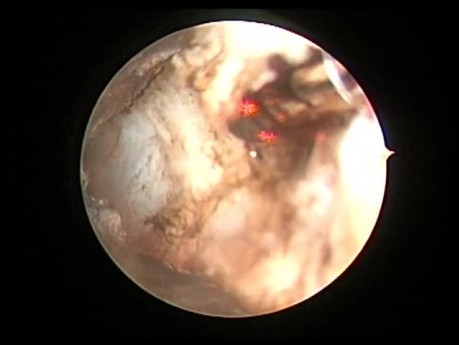 Greenlight HPS Prostatectomy - Bleeding