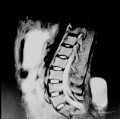 Meningocele in an 18-year-old patient