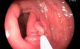 Ascending Colon Polyp