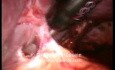Splenectomy - Laparoscopic Approach