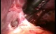 Splenectomy - Laparoscopic Approach