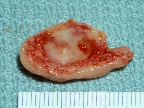 Concha Bullosa Operative Specimen