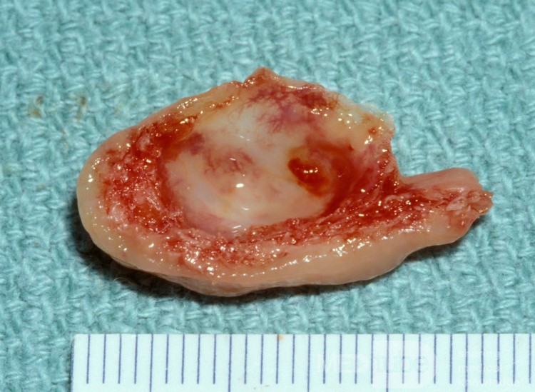 Concha Bullosa Operative Specimen