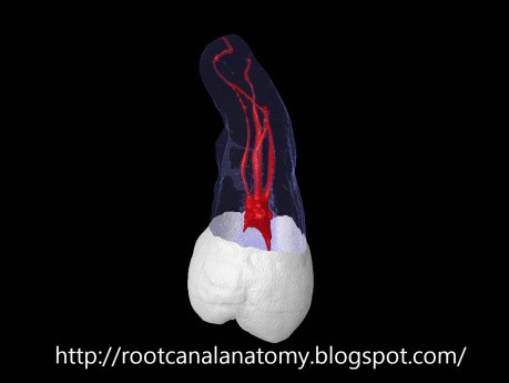 Maxillary Third Molar - Root Canal Anatomy
