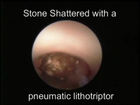 Endoscopic Lithotripsy Procedure