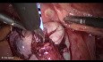 Laparoscopic Reimplantation of the Ureter to the Bladder for Endometriotic Structure of the Ureter