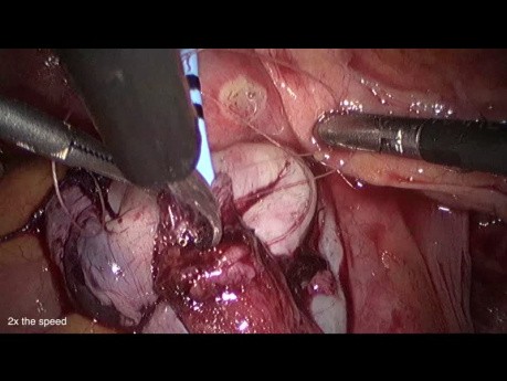 Laparoscopic Reimplantation of the Ureter to the Bladder for Endometriotic Structure of the Ureter