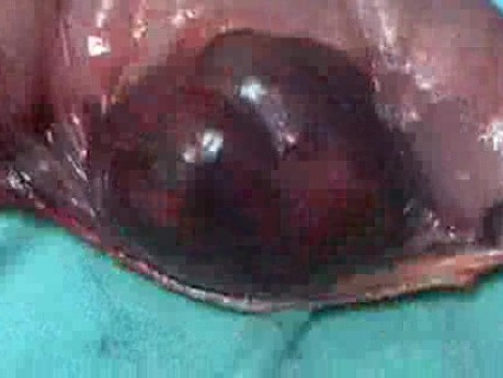 Jejunal Gastrointestinal Stromal tumor (GIST) (5 of 86)