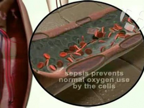 Sepsis