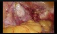 Hysterectomy Prev 2 lSCS Uterus