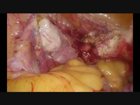Hysterectomy Prev 2 lSCS Uterus