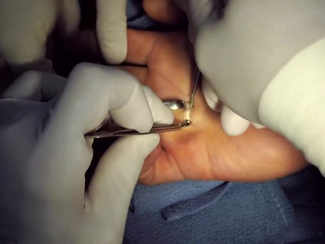 Trigger Finger Release