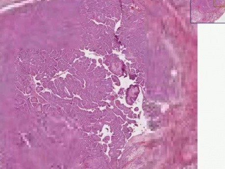 Papillary carcinoma