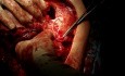 Chest Wall Fibrosarcoma