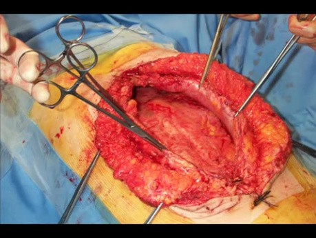 Abdominal closure after laparostomy