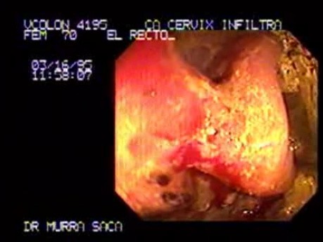Cervix Carcinoma Infiltrating the Rectum