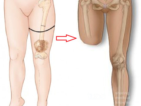 Above Knee Amputation