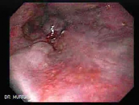 Hemorrhage After Ligation - Banding of Esophageal Varices with Red Sign