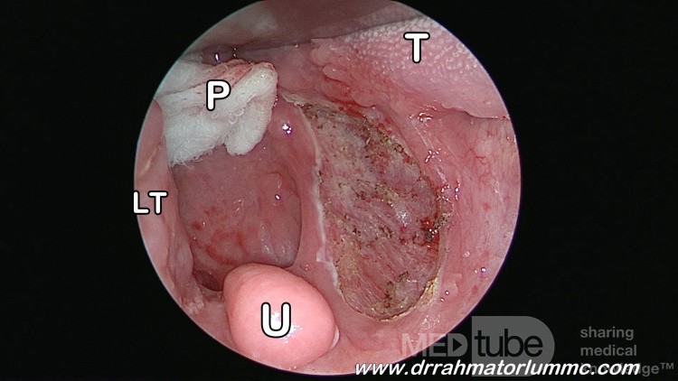 The Tonsil Bed After Tonsillectomy