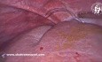 Accessory Grooves on the Diaphragmatic Surface of the Liver