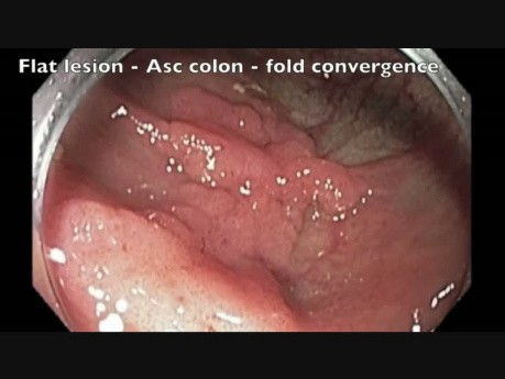 Colon EMR Perforation Analysis-A