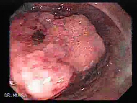 Rectal Adenocarcinoma - Colonoscopy (2 of 8)