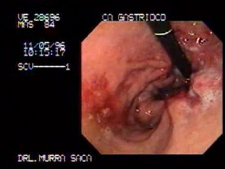 Adenocarcinoma of the Gastric Fundus - Patient With A Large Weight Loss