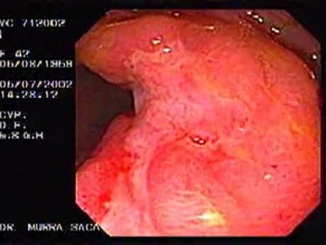 Crohn's Disease - Endoscopy (20 of 28)