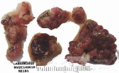Tubulo - Villous Rectal Adenoma - Endoscopy (24 of 35)