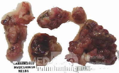 Tubulo - Villous Rectal Adenoma - Endoscopy (24 of 35)