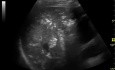 Aerobilia and Portal Venous Gas - Segmental Intestinal Ischemia and Pneumatosis Intestinalis