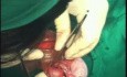 Orchidectomy And Orchidepexy Due To Testicular Torsion
