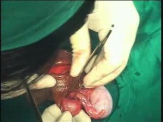 Orchidectomy And Orchidepexy Due To Testicular Torsion